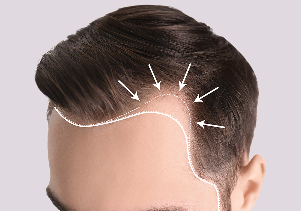 Centro médico Estético AYC, medicina estética en soria, tratamientos capilares