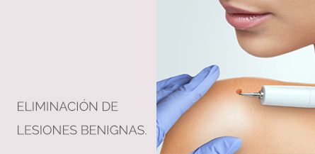 Eliminación lesiones benignas Centro Médico Estético AYC Soria