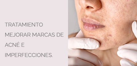 Tratamiento marcas Acné Centro Médico Estético AYC Soria