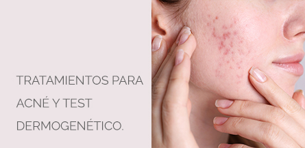Tratamiento Acné Centro Médico Estético AYC Soria