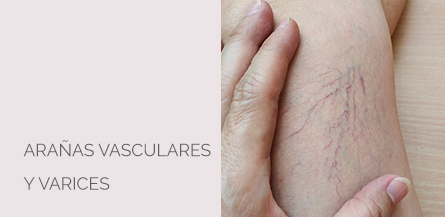 Centro Médico Estético Soria Arañas Vasculares y Varices