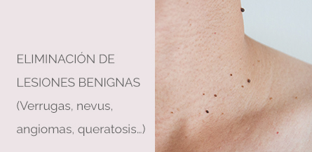 Eliminación lesiones benignas Centro Médico Estético AYC Soria