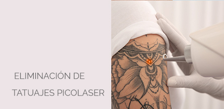 Centro Médico Estético AYC Soria Eliminación Tatuajes Picolaser
