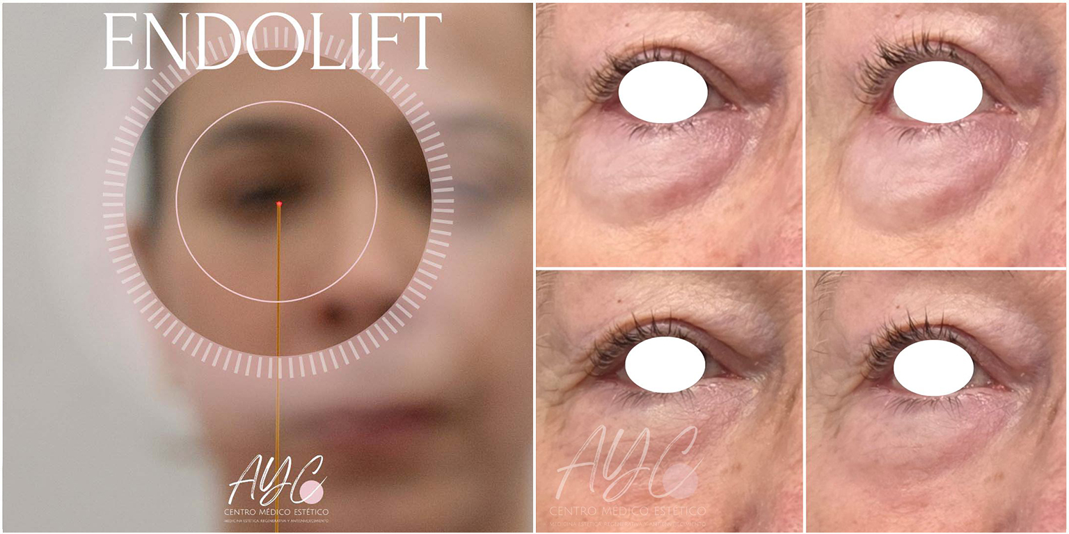 Tratamiento Endolift en clínica de medicina estética en Soria para tensado facial sin cirugía.