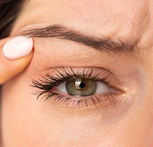 Blefaroplastia QuirÚrgica