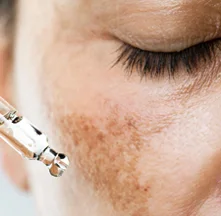 Tratamiento Para Melasma