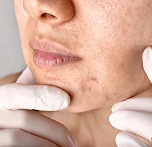 Tratamiento Mejorar Marcas De Acne